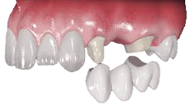 Geçici Diş Protezi