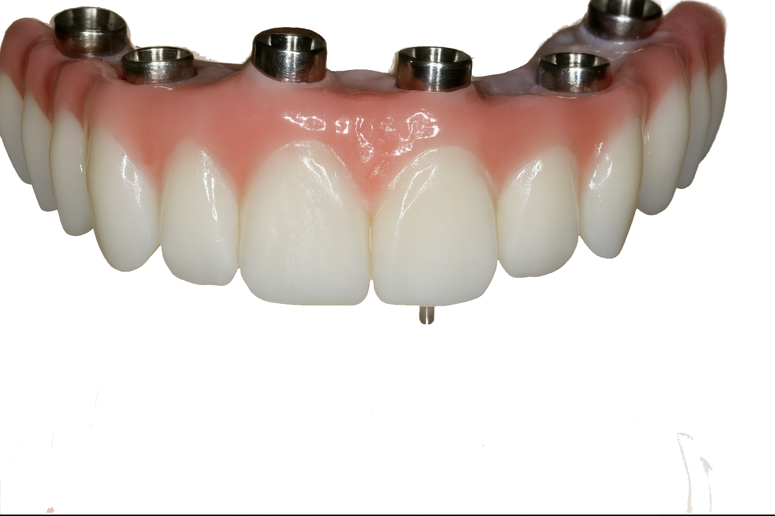 İmplant Üstü Protez